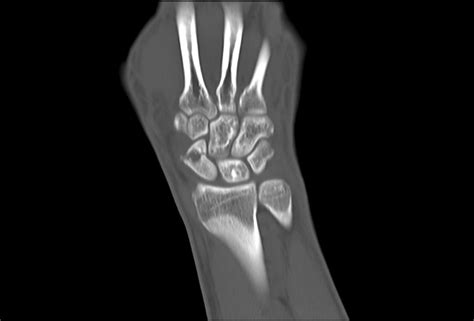Scaphoid Fractures Diagnosis And Management Sports Medicine Review