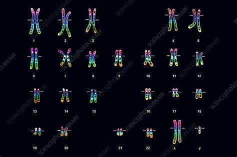 Klinefelters Syndrome Karyotype Male Stock Image C0037183