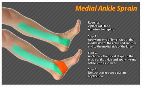 Kinesiology Taping Instructions For A Medial Ankle Sprain Ktape Ares