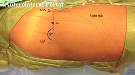 Basic Hip Arthroscopy Anatomic Establishment Of Arthroscopic Portals