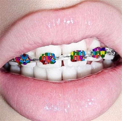 Patrizia Conde Pink Braces Cute Braces Colors Dental Braces