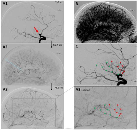Relevance Of The Cerebral Collateral Circulation In Ischaemic Stroke