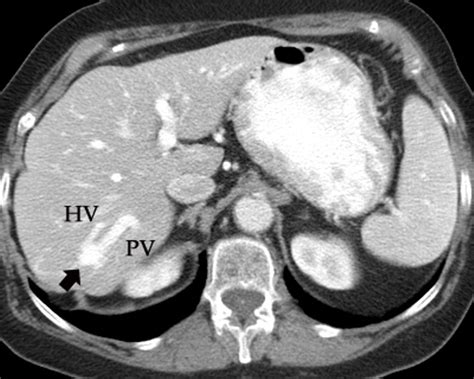 Liver Vascular Anatomy