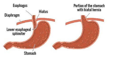 Natural Remedies For The Symptoms Of A Hiatal Hernia Step To Health