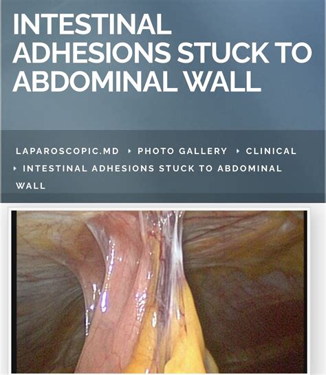 Photos Intestinal Adhesions Stuck To Abdominal Wall Abdominal