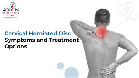 Cervical Herniated Disc Symptoms And Treatment Options