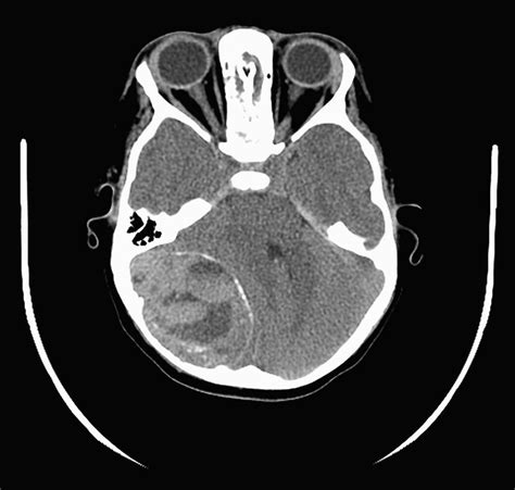 Giant Pediatric Aneurysmal Bone Cysts Of The Occipital Bone Case