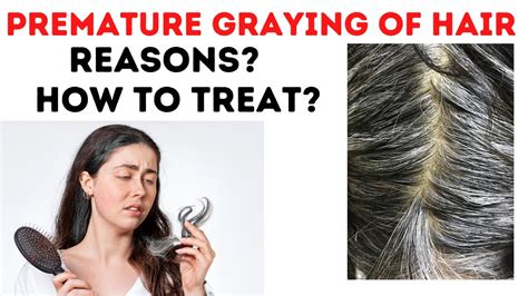 Premature Graying Of Hair How To Get Rid Of Gray Hair Naturally Youtube