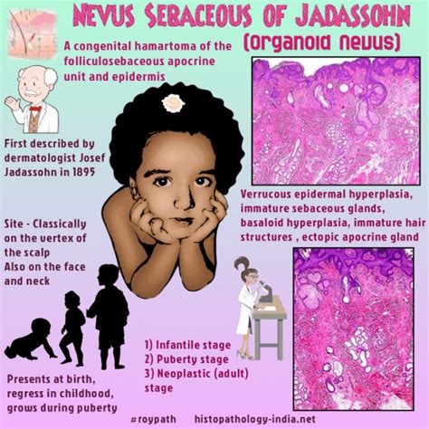 Pathology Of Nevus Sebaceous Organoid Nevus Dr Sampurna Roy Md