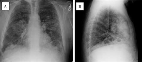 Chest X Rays A Postero Anterior View B Lateral View Reveal Diffuse