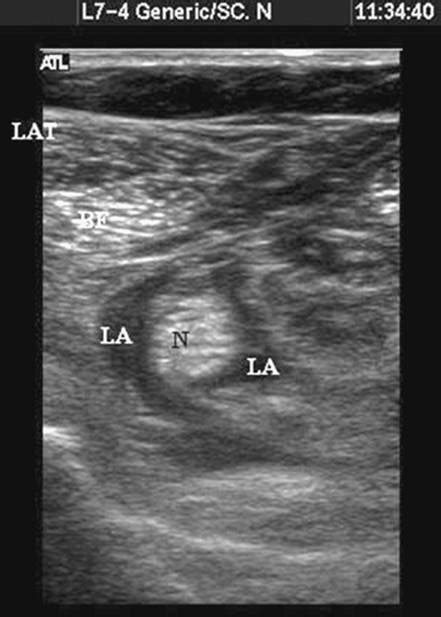 Ultrasound Guided Sciatic Block In The Popliteal Fossa Peripheral