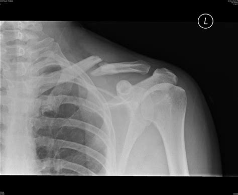 Collarbone Surgery Bones Displacing After Surgery Health And Fitness