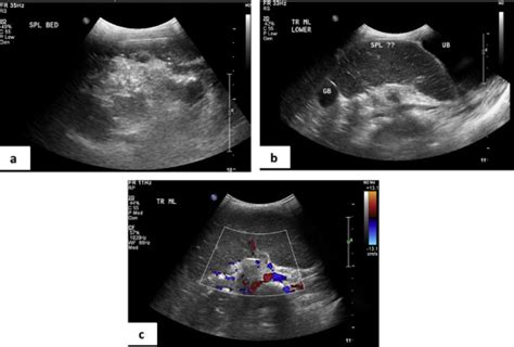 Ultrasound Images Of The Abdomen And Pelvis Show A Absent Spleen In