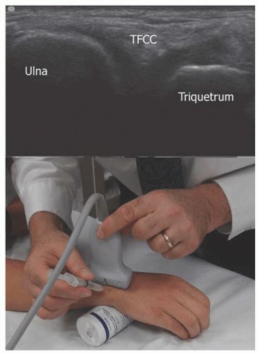 Ultrasound Guided Ulnar Triquetral Injection Anesthesia Key