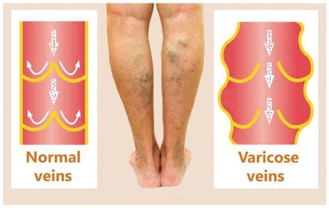 Advantages Of A Phlebectomy For Treating Varicose Veins Vein And Laser