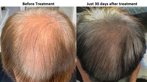 Exosome Treatment For Hair Loss Results At Just 40 Days Alviarmani Hair Transplant Los Angeles