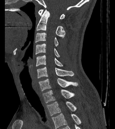Upper Images Sagittal Ct Scan Of Cervical Spinal Cord Images Show My