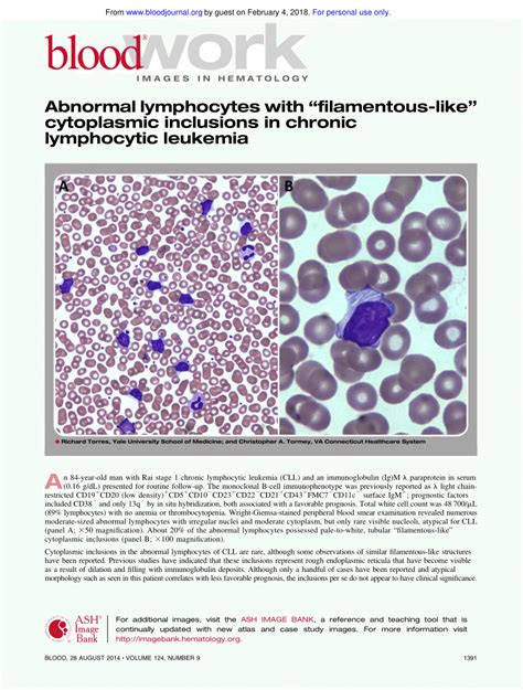Pdf Abnormal Lymphocytes With Filamentous Like Cytoplasmic
