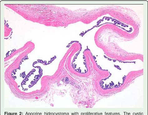 Apocrine Hidrocystoma With Proliferative Features Apocrine Cystadenoma