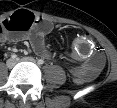 Ct Enterography Principles Trends And Interpretation Of Findings