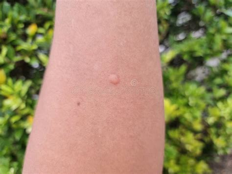 A Mosquito Bites A Blister On The Arm Stock Image Image Of Swollen