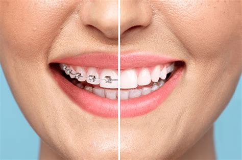 3 Surprising Facts About Adult Braces You Should Know Clear Smiles