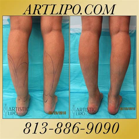 Cankles Ankles Calves And Knees Are Areas That Many Women Arent Aware That Liposuction