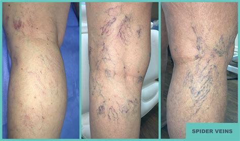 What Causes Spider Veins