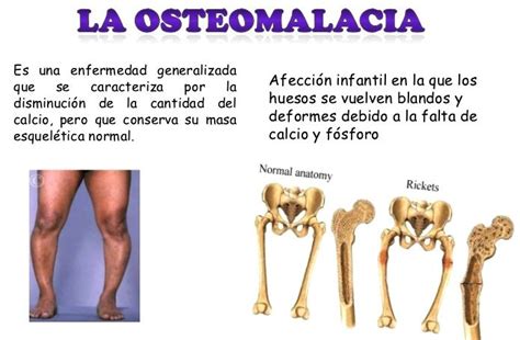 La Osteomalacia Una Enfermedad De Hueso Que Deberíamos Conocer Blog