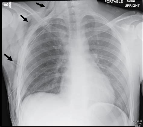 Wheres The Air Pneumothorax Radiology Key