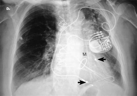 Postoperative Chest Radiograph In The Same Patient Shown In Fig 3