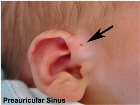 Neonatal Pre Auricular Pitssinuses Survey Of Management Strategies By