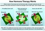 Photos of Treatment Of Menopausal Symptoms With Hormone Therapy
