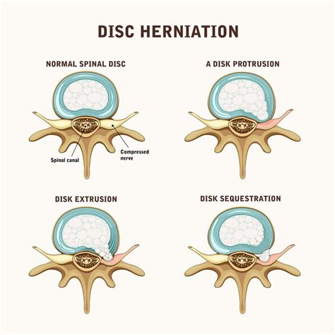 Disc Herniation Size Chart