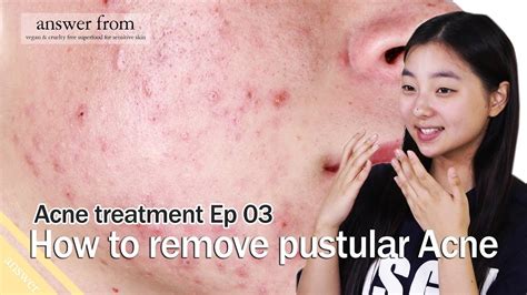 Acne Treatment Ep 03 How To Remove Pustules Acne Youtube