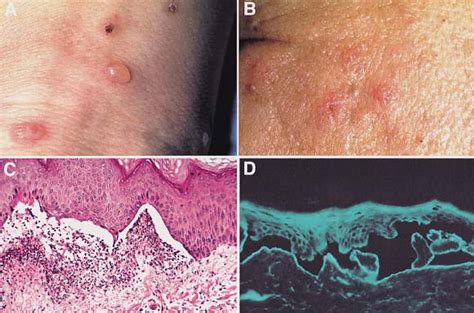 Anti P200 Pemphigoid Diagnosis And Treatment Of A Case Presenting As