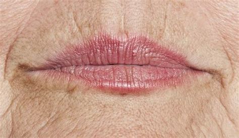 Wrinkly Lips Can Be Annoying And Unattractive Learn The Cause Of