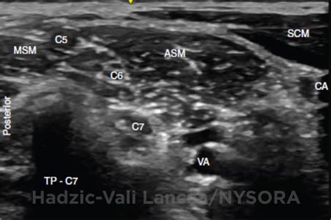 Ultrasound Guided Interscalene Brachial Plexus Block Nysora The New