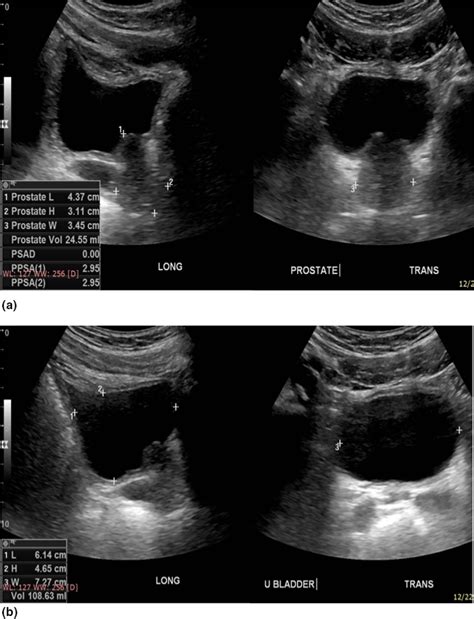 Pelvic Ultrasound Done With A Urine Volume Of 1086 Ml Shows A Prostate