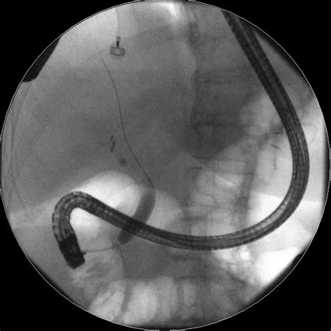 Eus Directed Transgastric Ercp For Roux En Y Gastric Bypass Anatomy A