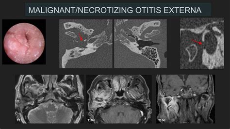 Necrotizing Otitis Externa