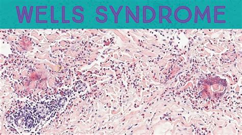 Wells Syndrome Eosinophilic Cellulitis With Flame Figures Pathology