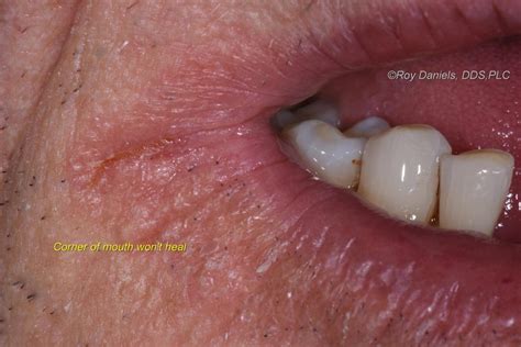 Sores In Corners Of Mouth From Vitamin Deficiency