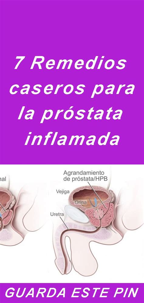 Quanto tempo per avere risultati biopsia prostata remedios casero para prostata inflamada. 7 Remedios caseros para la próstata inflamada | Prostata ...