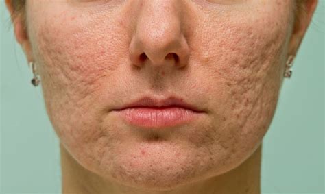 The Best Way To Get Rid Of Your Acne Scars Wellbeing Clinic