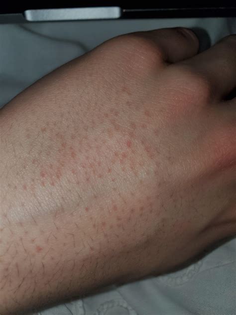 red dots on back of hands r accutane