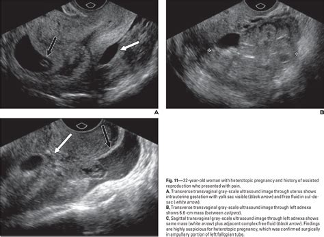 Figure From Imaging Unusual Pregnancy Implantations Rare Ectopic
