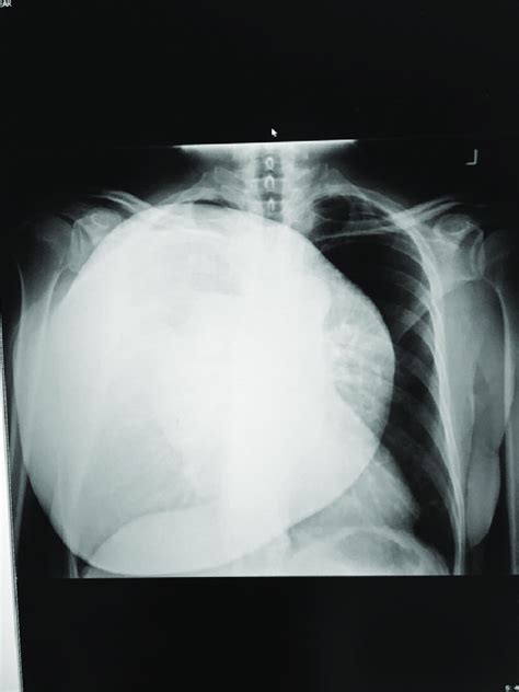 Chest X Ray Showing A Large Lobulated Soft Tissue Mass Overlying The
