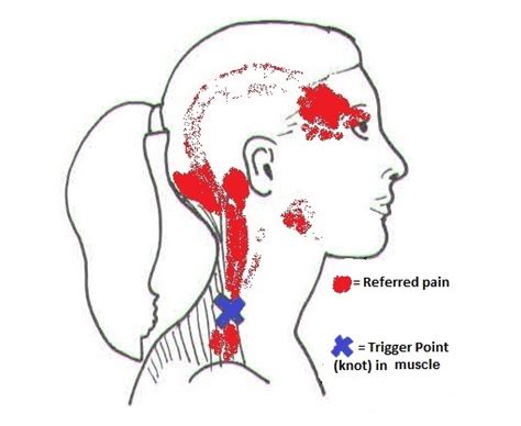 Neck Pain Base Of Head