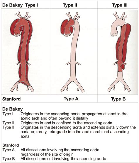 Aortic Dissection Stepwards